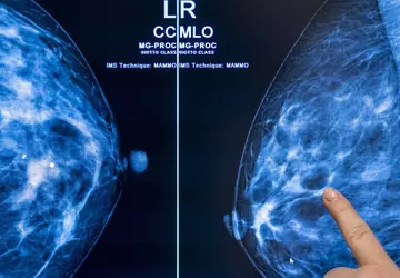 Kankerscreening met kunstmatige intelligentie kan werklast ...